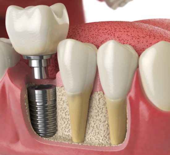 Czy implanty dentystyczne są dla Ciebie odpowiednie?