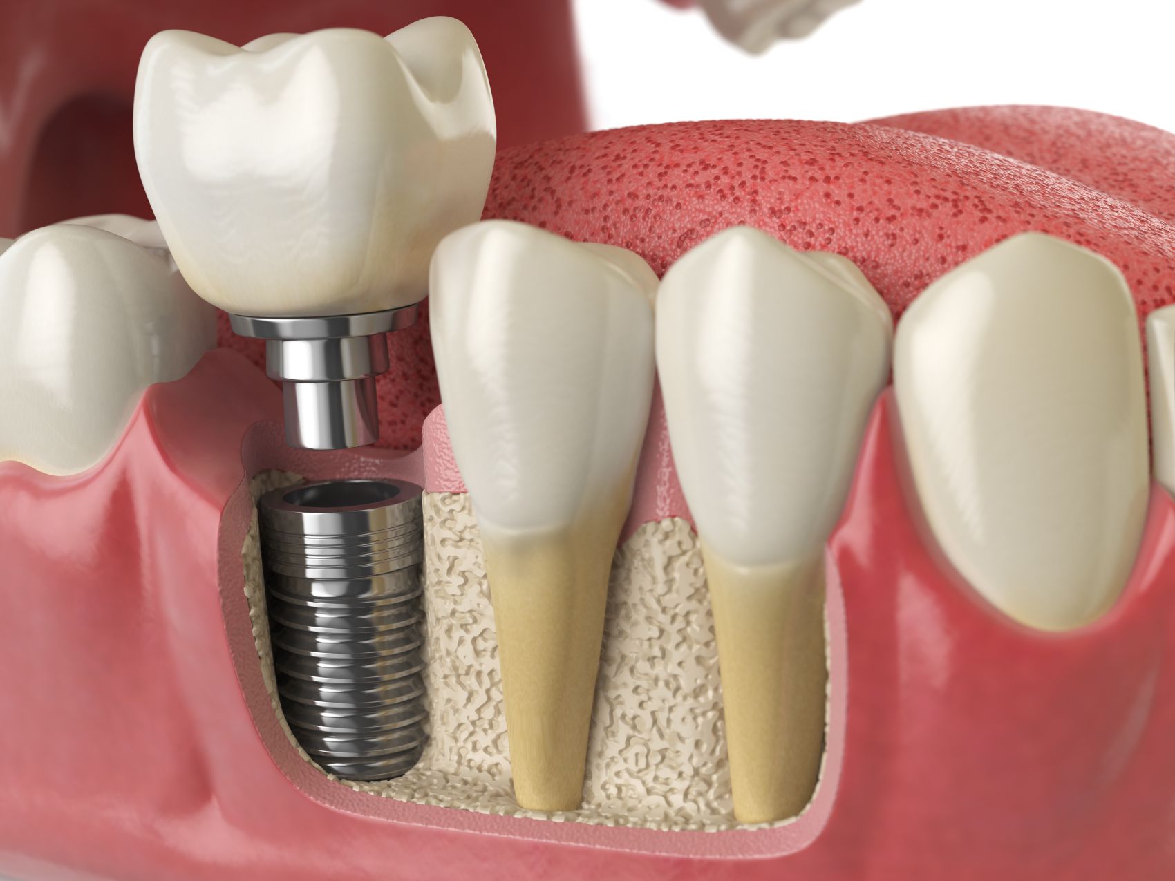 Czy implanty dentystyczne są dla Ciebie odpowiednie?