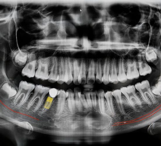 Jak często można wykonywać zdjęcia rentgenowskie zębów i czy są one bezpieczne?
