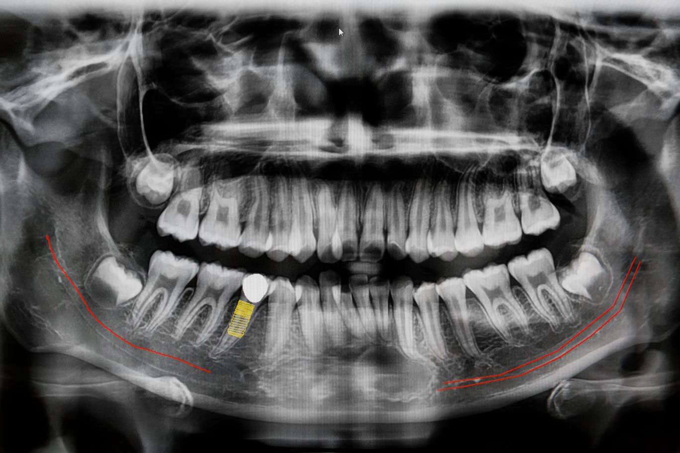 Jak często można wykonywać zdjęcia rentgenowskie zębów i czy są one bezpieczne?