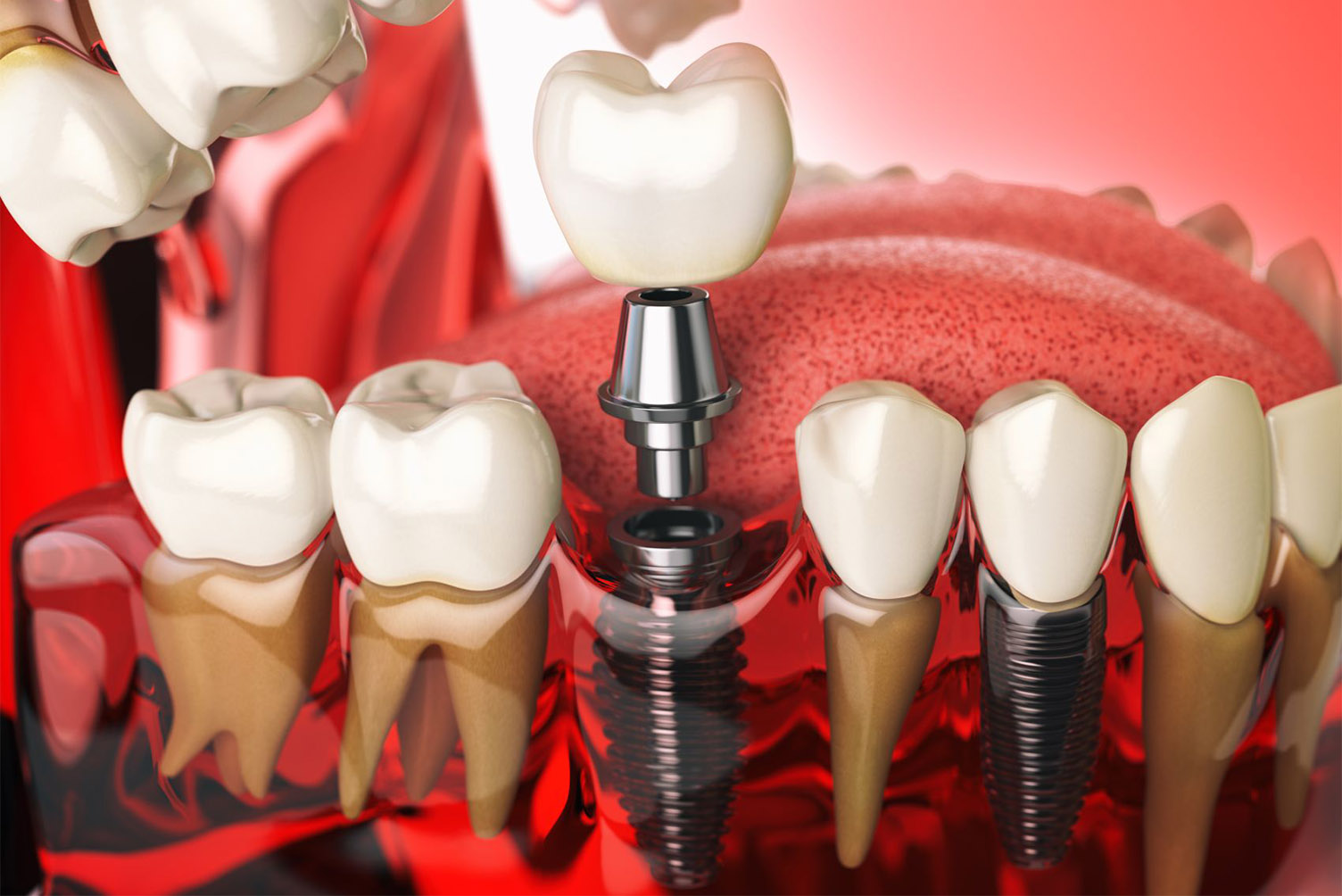 Co nowego w implantologii stomatologicznej?
